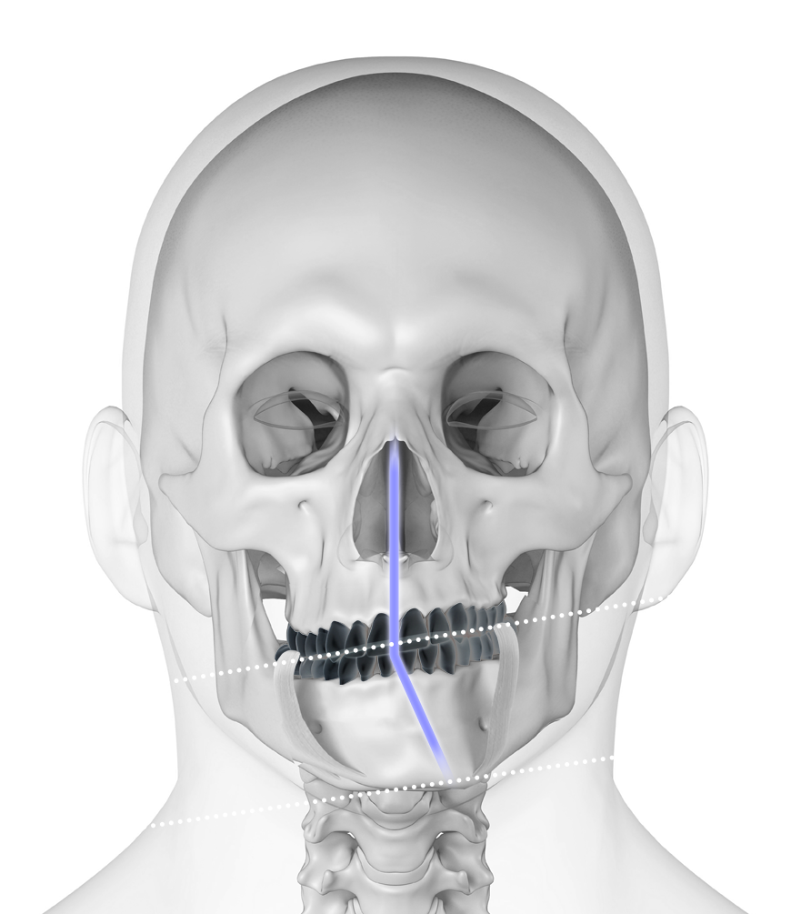 비대칭 두개골 3D 사진