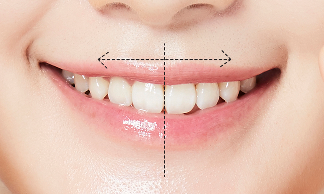 치아 좌우 대칭 사진