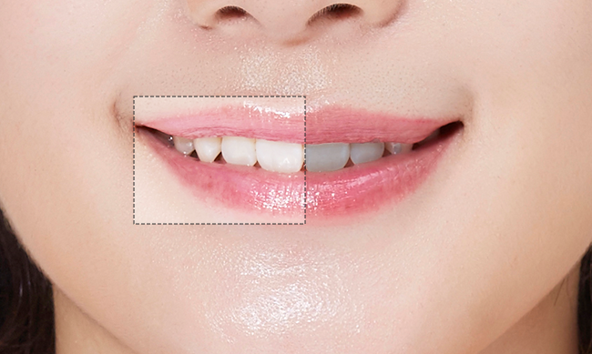 치아 색조 비교 사진